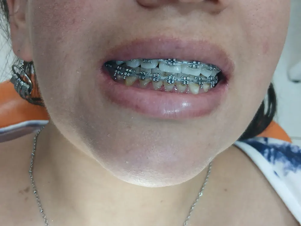 Antes: paciente durante su tratamiento de ortodoncia con brackets metálicos