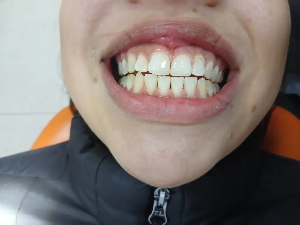 Después: dientes alineados de la misma paciente al finalizar la ortodoncia
