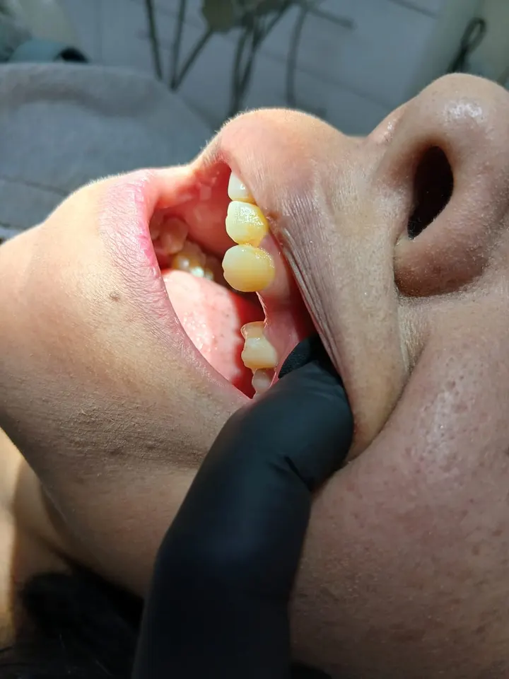 Antes: vista lateral de la boca con espacios por piezas dentales ausentes