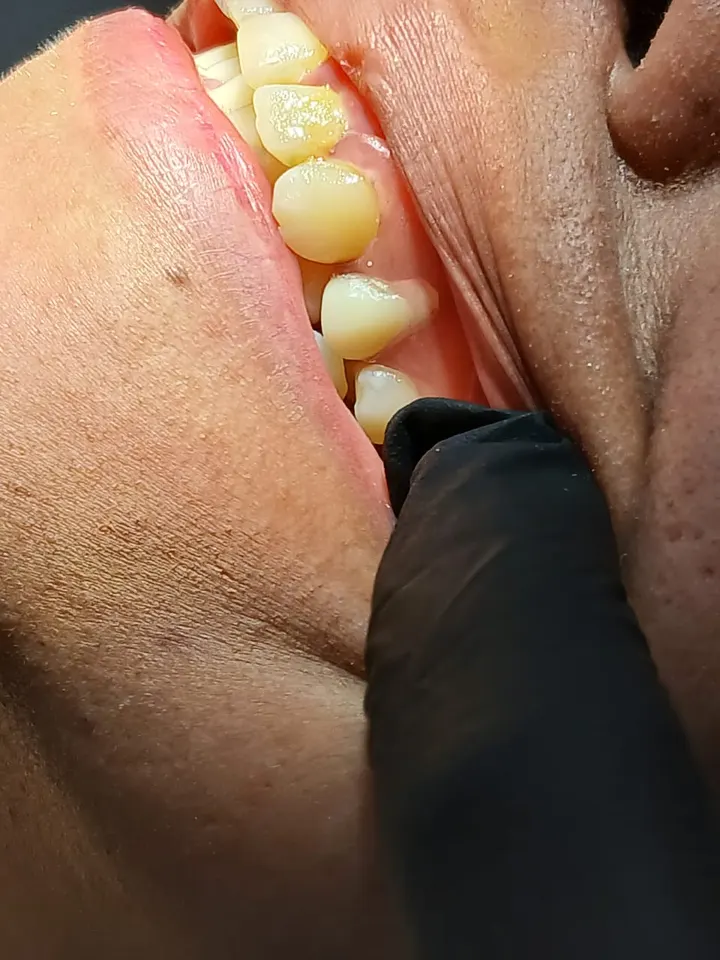 Después: vista lateral de la boca con las piezas dentales rehabilitadas